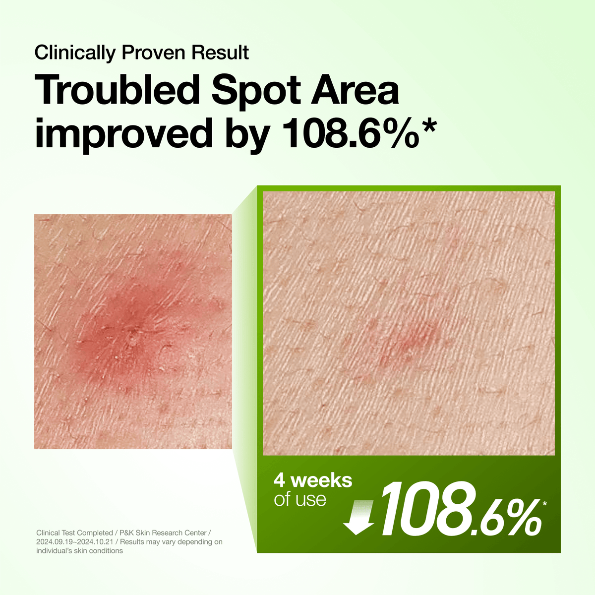 Anua Azelaic Acid 10 Hyaluron Redness Soothing Serum αποτελέσματα δοκιμής